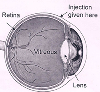 intravitreal-nioeyes-clinic