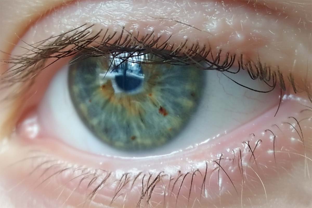 Diabetic Retinopathy