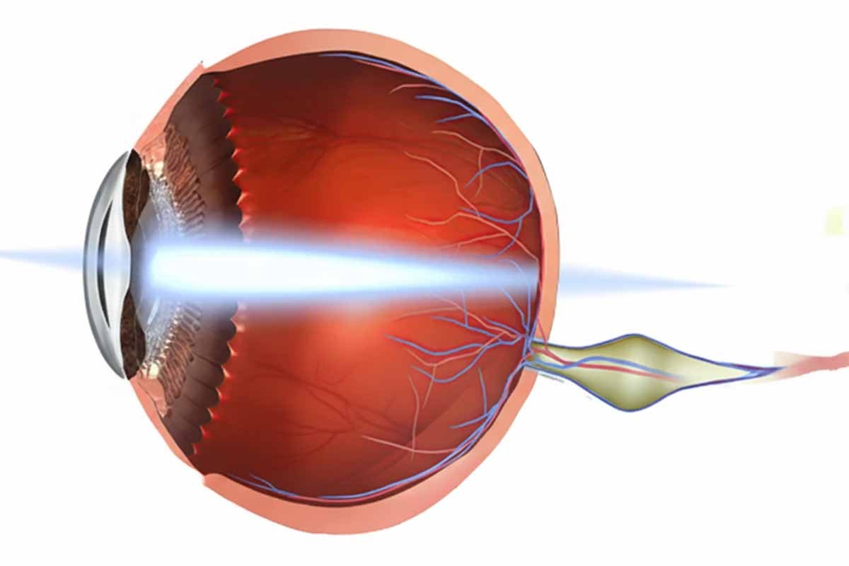 Retina – Macular Hole
