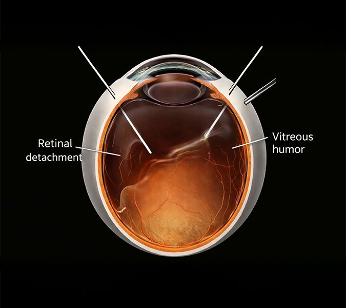 Common Retinal Conditions Treated with Surgery
